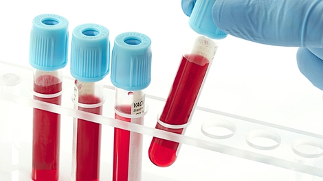Des microplastiques détectés dans du sang humain