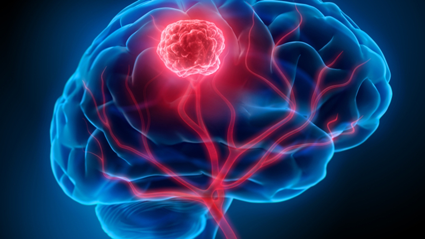 Tumeurs du cerveau : ce que peut la chirurgie - AlloDocteurs