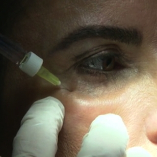 Rides : des crèmes aux injections