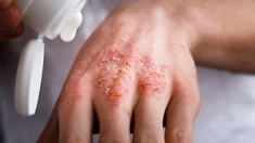 Eczéma : les bons gestes