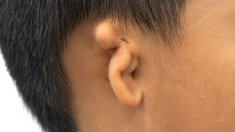Une première greffe d’oreille à partir de cellules humaines réalisée grâce à une imprimante 3D