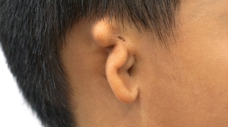 Une première greffe d’oreille à partir de cellules humaines réalisée grâce à une imprimante 3D