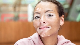 Vitiligo, quand la peau perd sa couleur