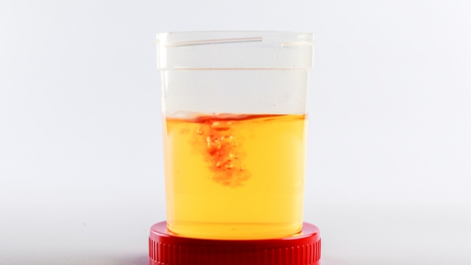 Hématurie : à quoi est dû le sang dans les urines ?