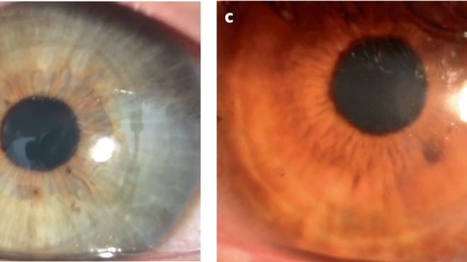 Photographies des yeux de deux patients, quatre mois après l'opération