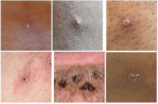 Les différentes étapes des lésions dues à la variole du singe. En haut : les trois images montrent les pustules à un état peu avancé. Elles ressemblent à des vésicules remplies de liquide. En bas : les vésicules sont plus avancées et évoluent en croûtes.