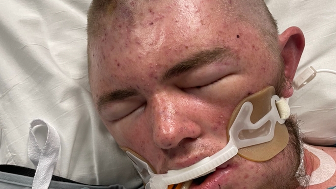 Austin Bellamy, 20 ans, a été piqué 20 000 fois par des "abeilles tueuses"