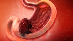 Cancer de l’estomac : quels symptômes doivent alerter ?