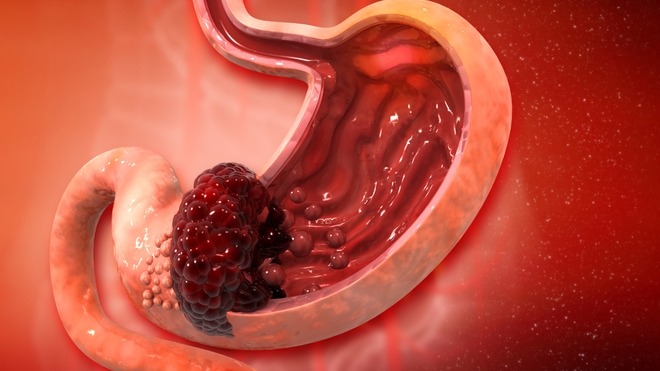 Plusieurs facteurs favorisent l’apparition d’un cancer de l’estomac