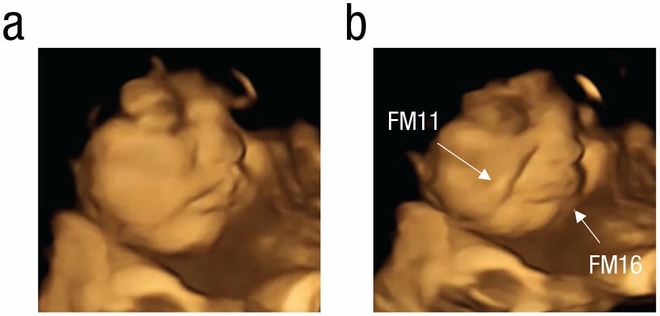 IMAGE 2 - À gauche (a) : foetus au visage neutre ; à droite (b) : foetus au visage grimaçant survenu quand sa mère a consommé du chou kale.