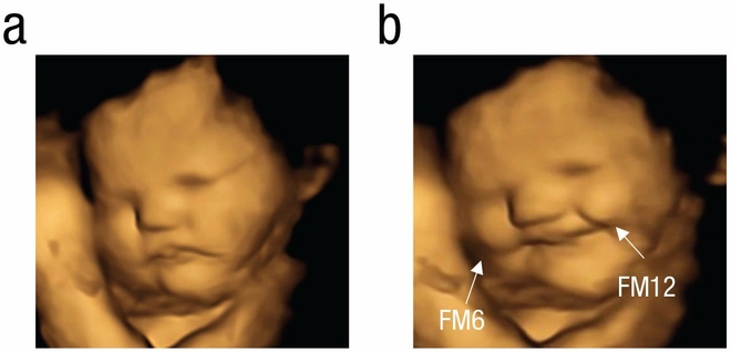 IMAGE 1 - À gauche (a) : foetus au visage neutre ; à droite (b) : foetus au visage riant correspondant à la consommation de carotte par sa mère.