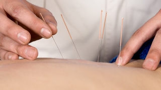Qui a inventé l’acupuncture ?