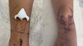 Un nez implanté sur l’avant-bras d'une patiente avant d’être greffé sur son visage