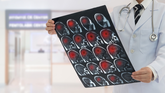 Le système d'intelligence artificielle Brainomix e-Stroke réduit de plus d'une heure le diagnostic de l'AVC et permet de choisir rapidement le traitement le plus adapté