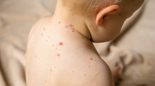Votre enfant se gratte : et si c'était la varicelle ?