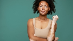 Vitiligo : un traitement prometteur pour repigmenter la peau