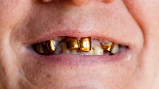 Implants, couronnes... depuis quand remplace-t-on les dents ?