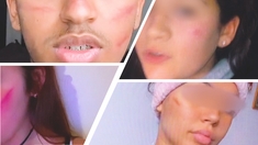 Sur TikTok, le défi des cicatrices défigure les adolescents