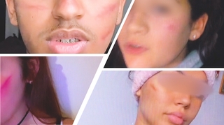 Sur TikTok, le défi des cicatrices défigure les adolescents