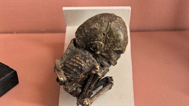 Un lithopédion porté pendant 18 ans par une femme, autopsié en 1851 et exposé au Musée Flaubert et d’histoire de la médecine à Rouen