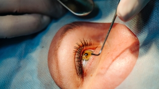 Faut-il avoir peur de la chirurgie de la cataracte ?