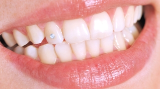 Le strass dentaire, une mode dangereuse pour vos dents ?		