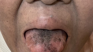 Une langue noire et chevelue, suite à un antibiotique ? Oui, c'est possible !