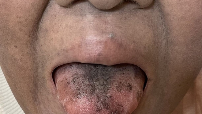 Une patiente japonaise a développé une langue noire chevelue en prenant un antibiotique.