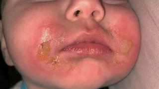 "Brûlure de la margarita" : un bébé gravement brûlé après avoir mangé du céleri