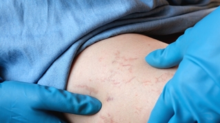 Varices : comment les prévenir ?
