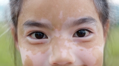 Vitiligo : les enfants sont aussi concernés
