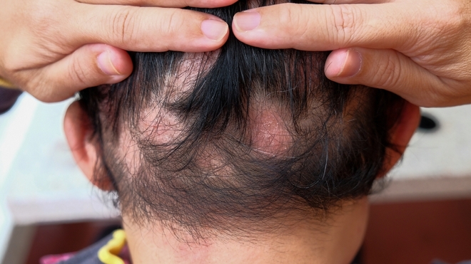 L’alopécie aerata sévère ou pelade est une forme sévère de l’alopécie où la perte de cheveux se fait sous forme de plaque sans cuire de cheveu localisé