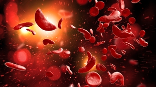 La drépanocytose, une maladie des globules rouges
