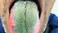 Un homme voit sa langue devenir verte et poilue après avoir pris un médicament
