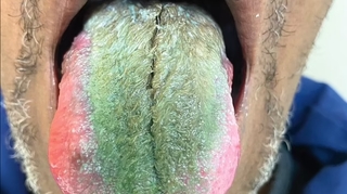 Un homme voit sa langue devenir verte et poilue après avoir pris un médicament