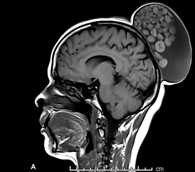 Image IRM du crâne de la patiente