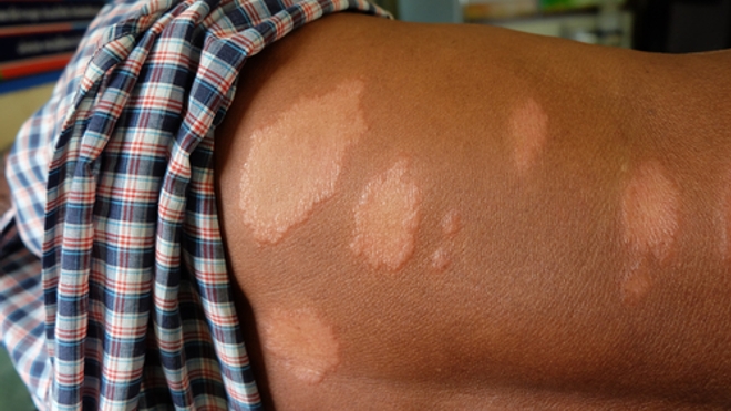 La lèpre se caractérise principalement par des lésions rouges sur la peau, marquées par un centre moins pigmenté que les bords.