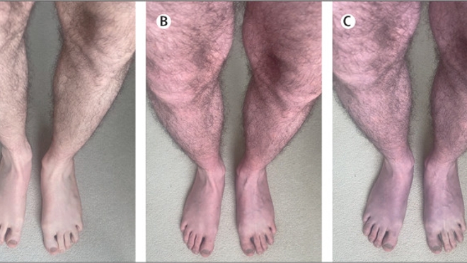 Les jambes du patient après être resté debout 0 minute (A), 2 minutes (B) et 10 minutes (C)