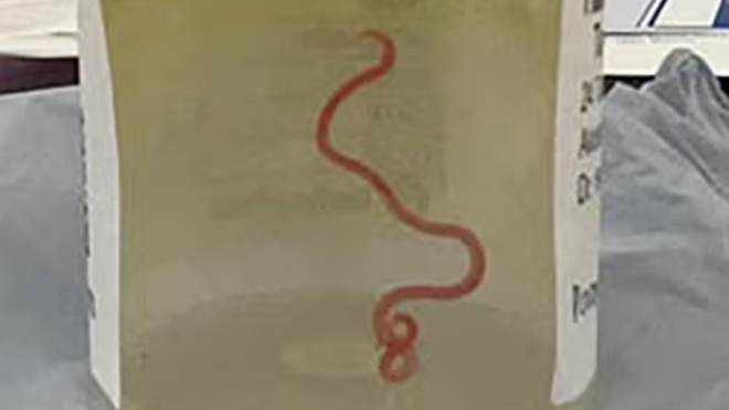 Un ver vivant de 8 cm a été retrouvé dans le cerveau d'une Australienne