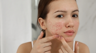 Comment avoir moins de boutons d’acné ?   