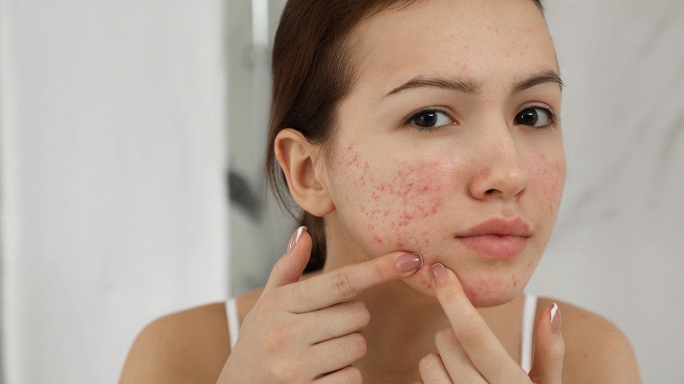 Comment avoir moins de boutons d’acné ? - AlloDocteurs