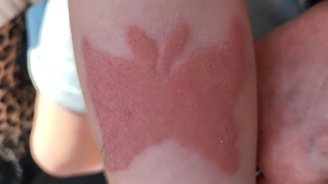 Le tatouage au henné de 3 cm en forme de papillon a laissé place à une impressionnante réaction cutanée