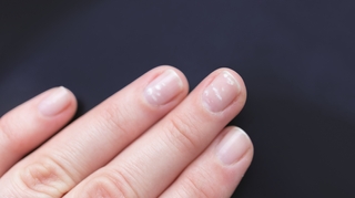Quelle est la cause des taches blanches sur les ongles ?