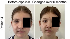 Un nouveau traitement transforme le visage d'enfants souffrant d'une malformation faciale