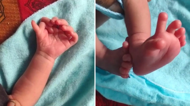 La fillette est née avec sept doigts à chaque main et six orteils à chaque pied