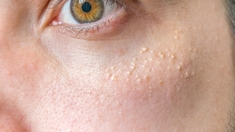 Boutons blancs : comment se débarrasser des grains de milium sur le visage ?