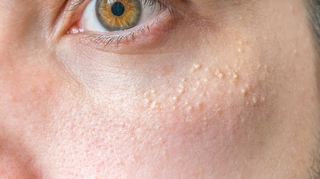 Boutons blancs : comment se débarrasser des grains de milium sur le visage ?