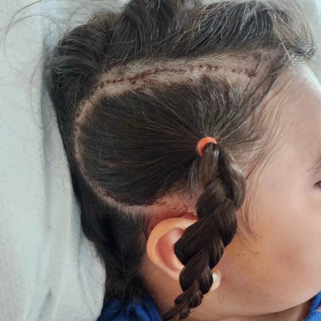Les cicatrices de l'opération du cerveau sur la fillette de 6 ans