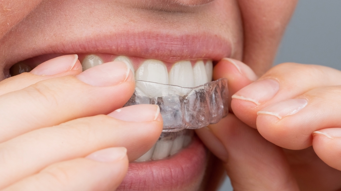 Gouttières d'alignement dentaire : attention aux produits vendus