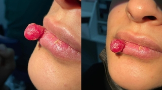 Deux femmes enceintes développent des tumeurs après s’être mordues la lèvre et la langue